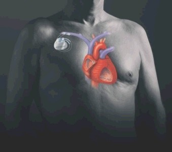 Moderner Herzschrittmacher