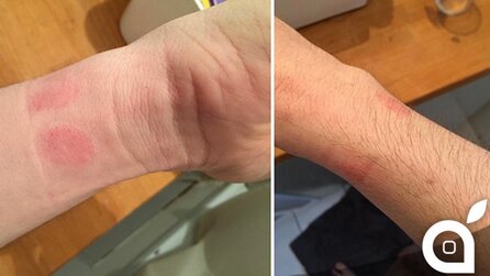 Apple Watch - Nutzer berichten über Hautprobleme, Nickel im Verdacht