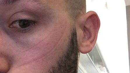 Oculus-Gesicht + Rift-Ausschlag - Nebenwirkungen von Virtual Reality