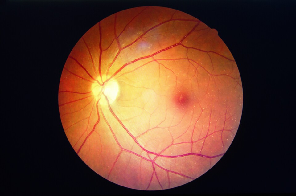 So in etwa sieht dier Fundus oculi für den Augenarzt bei der Untersuchung aus. (koolsabuy, Adobe Stock)